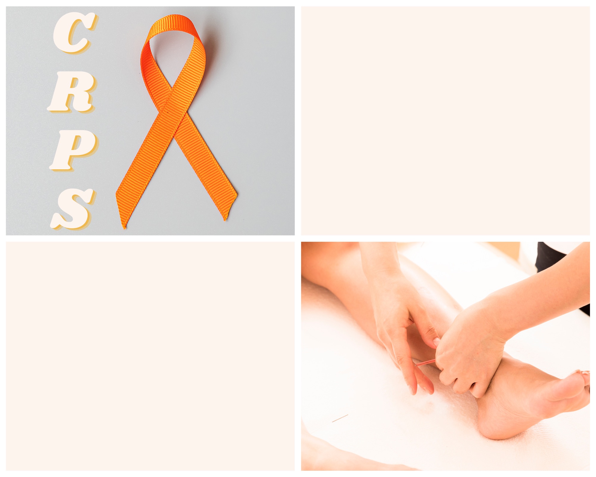 Understanding CRPS: Can Acupuncture Bring Relief?