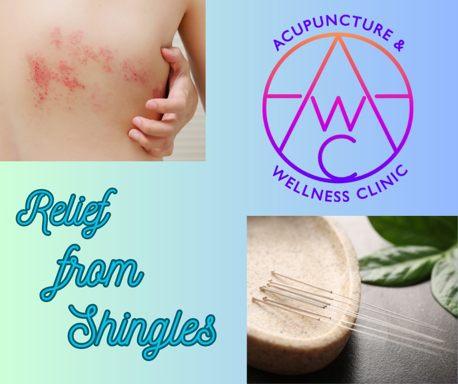 The Healing Power of Acupuncture in Treating Shingles