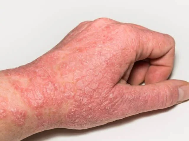 Eczema Relief for Kids and Adults: A Natural Solution at Acupuncture Wellness Clinic in Burlington, MA
