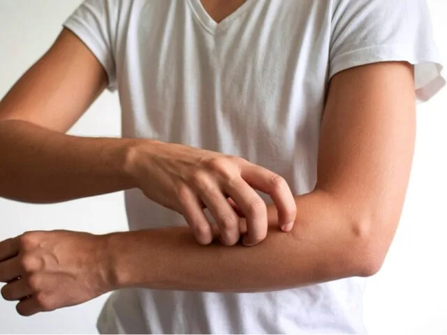 Stop the Itch: How Acupuncture Helps Eczema, Psoriasis, Hives & Chronic Itchy Skin in Greater Boston